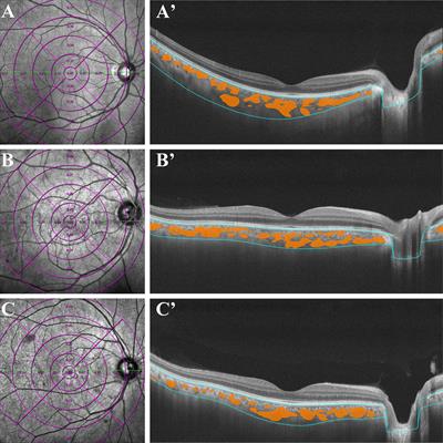 Assessment of choroidal structural changes in patients with pre- and early-stage clinical diabetic retinopathy using wide-field SS-OCTA
